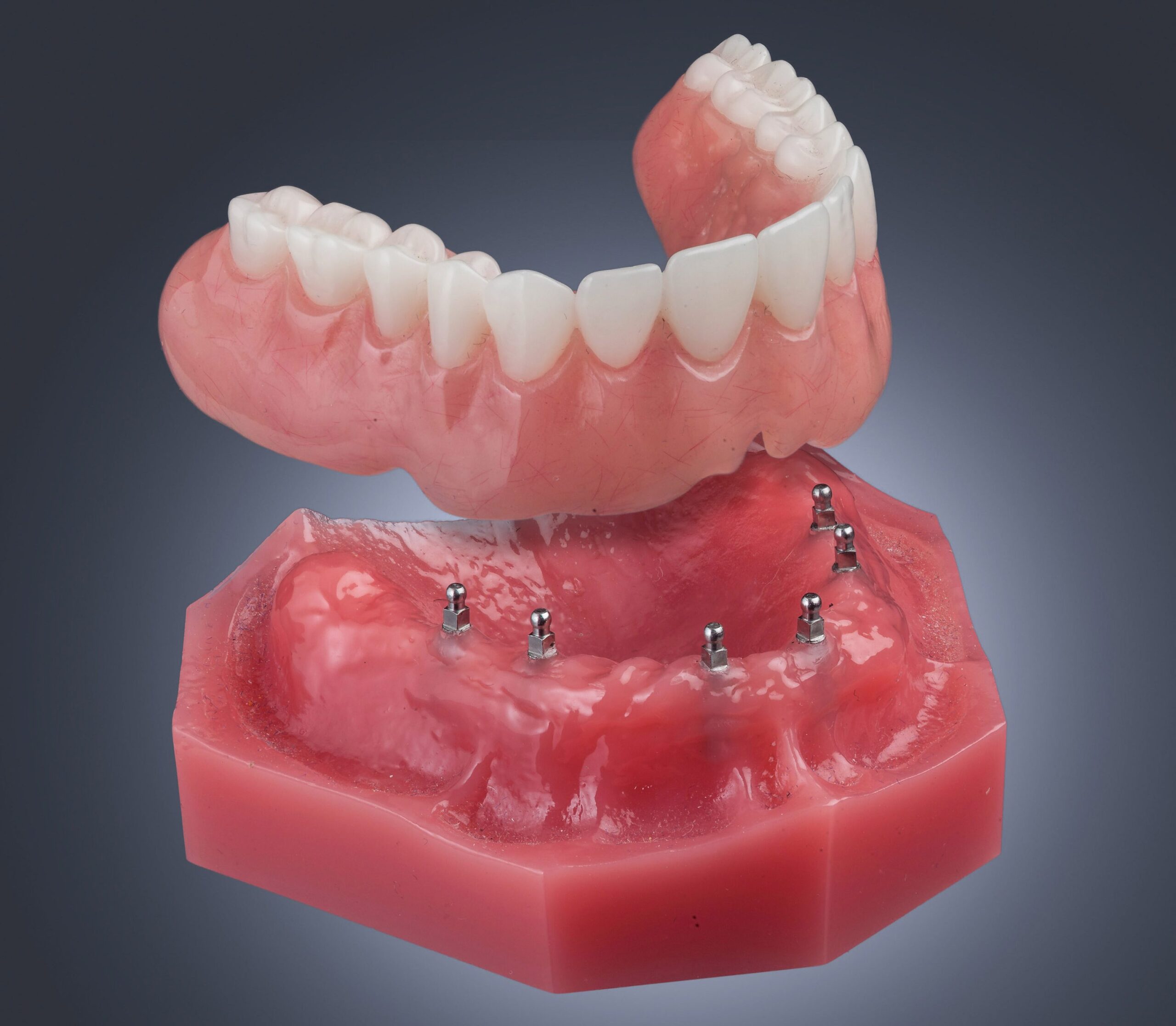 Implant Supported Denture