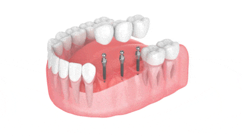 Multiple Tooth Replacement with Dental Implant Bridge