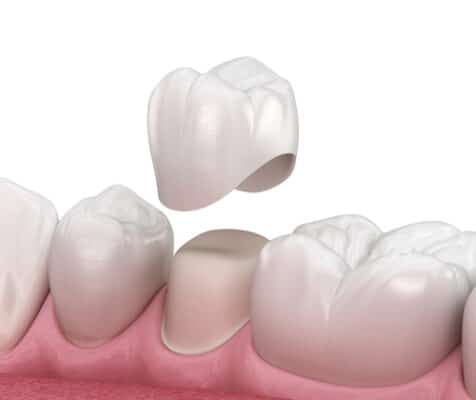 Dental Crowns in Dunn, NC | J. Michael Williams, DDS