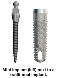 Dental Implants in Dunn, NC | J. Michael Williams, DDS