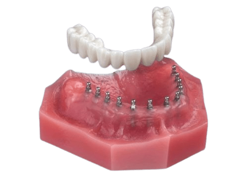 Implant Dentures in Dunn, NC | J. Michael Williams, DDS