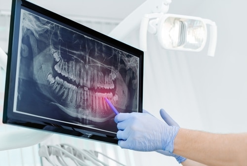 Oral Surgery in Dunn, NC | J. Michael Williams, DDS | Tooth Pain