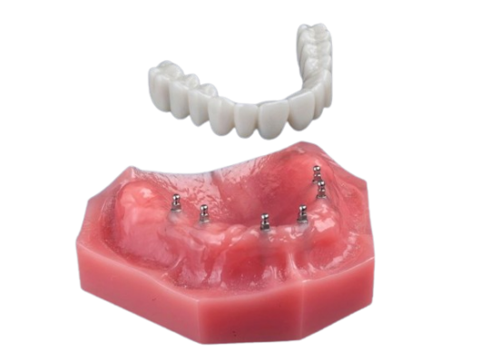 All-on-4 Alternatives in Dunn, NC | Free Implant Consultations