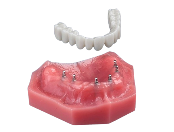 All-on-4 Alternatives in Dunn, NC | Free Implant Consultations