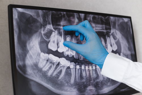 Dental Extractions in Dunn, NC | Protect Your Oral Health Today!