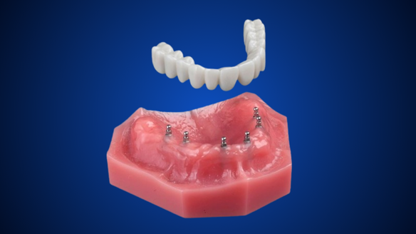 Fix-on-Six in Dunn, NC | Implant Denture | Affordable Mini Implants