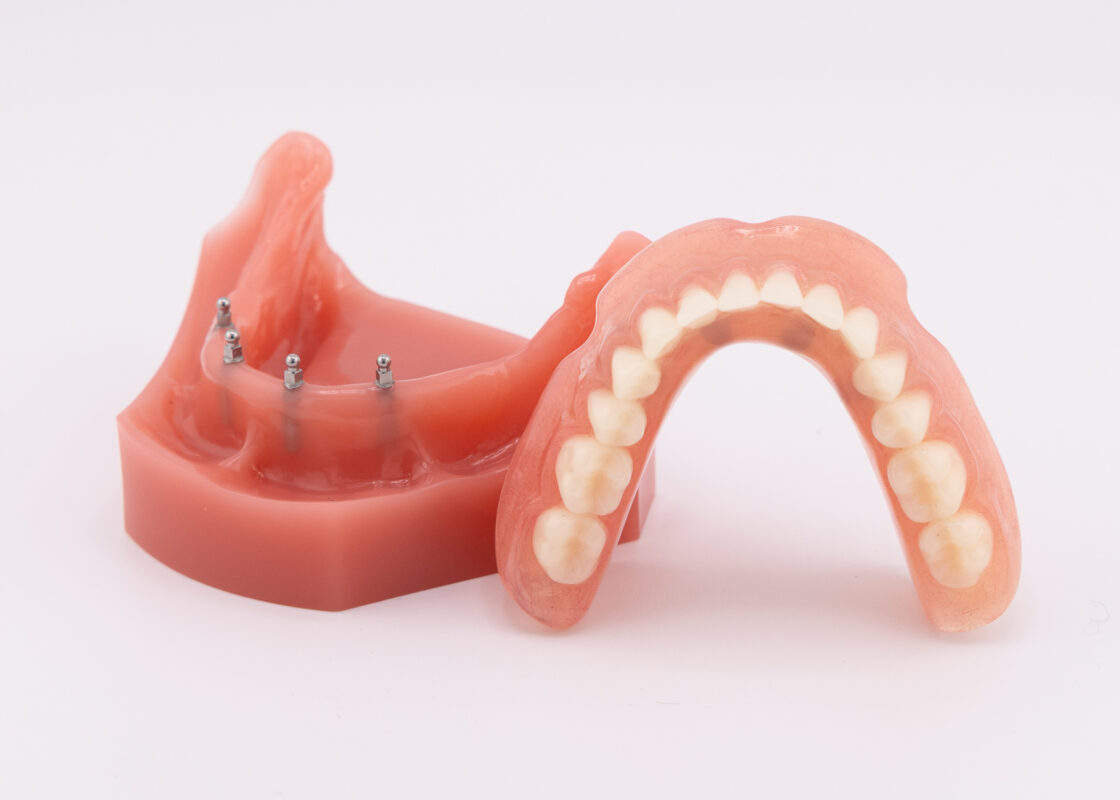 Denture Options in Dunn, NC | Affordable Mini Dental Implants