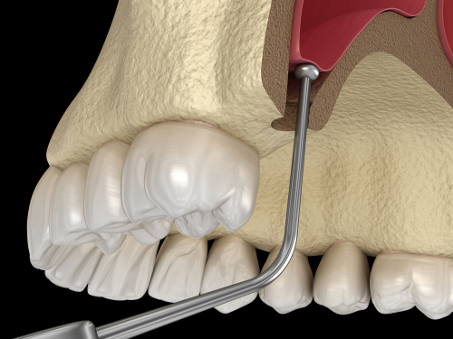 Sinus Lift Treatment in Dunn, NC | Support for Dental Implants