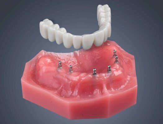 All-on-4 Alternatives in Dunn, NC | Free Implant Consultations