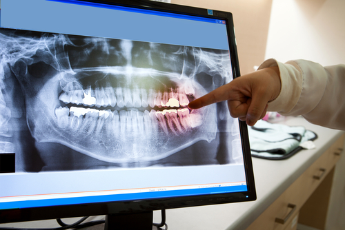 Car Accident Dental Care in Dunn, NC | Same-Day Dental Care