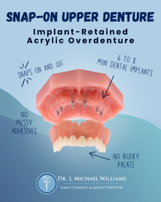 Palateless Dentures in Dunn, NC | Snap-On Upper Denture Without Palate
