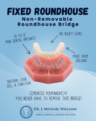 Permanent Dentures in Dunn, NC | Free Implant Consultations | Non-Removable Roundhouse Bridge